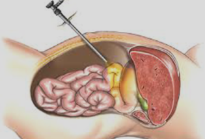 Lap Cardiomyotomy Treatment in Pune