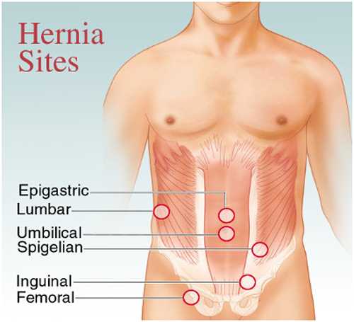 Laparoscopic Hernia Treatment in Pune- Dr. Sudhir Jadhav