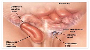 Hernia Specialist in pune,Hernia Treatment in pune