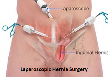 Laproscopic Hernia Treatment in Pune- Dr.Sudhir Jadhav
